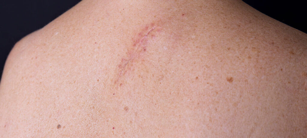 A close up of a back with a scar