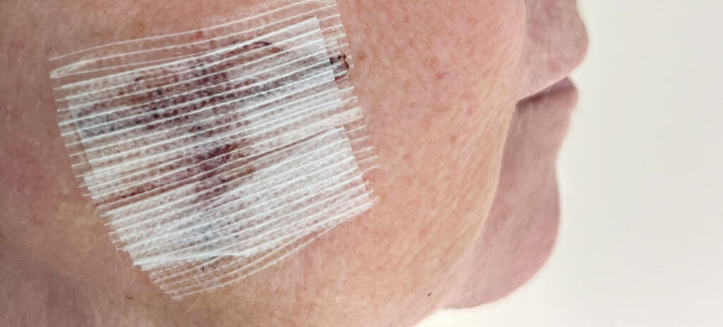 A close up of a cheek with a bandage