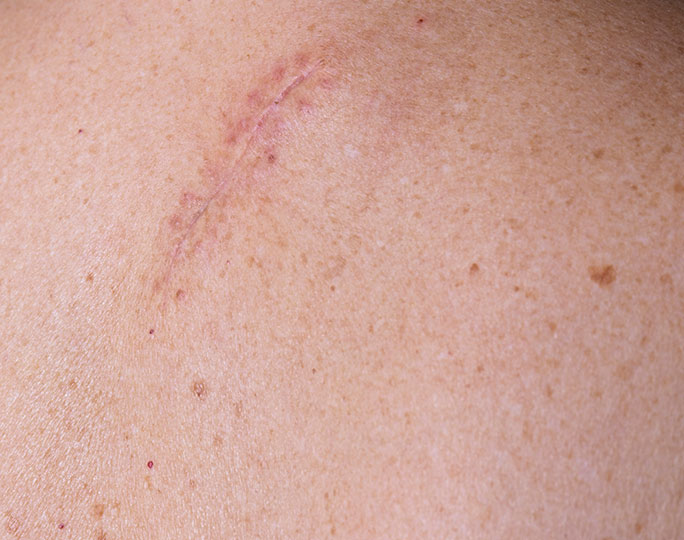 A close up of a back with a scar